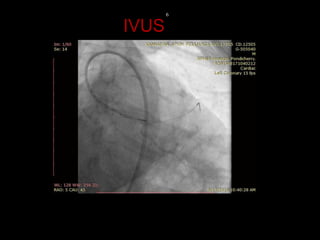 IVUS
6
 