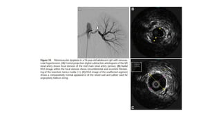Ivus Peripheral Radiology Intravascular Ultrasound (IVUS).pptx