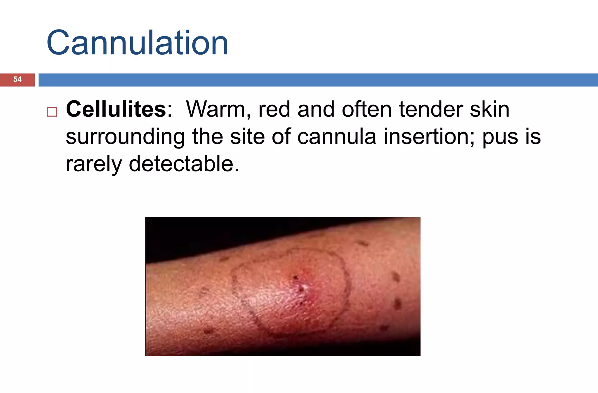 Cannulation
 Cellulites: Warm, red and often tender skin
surrounding the site of cannula insertion; pus is
rarely detectable.
54
 