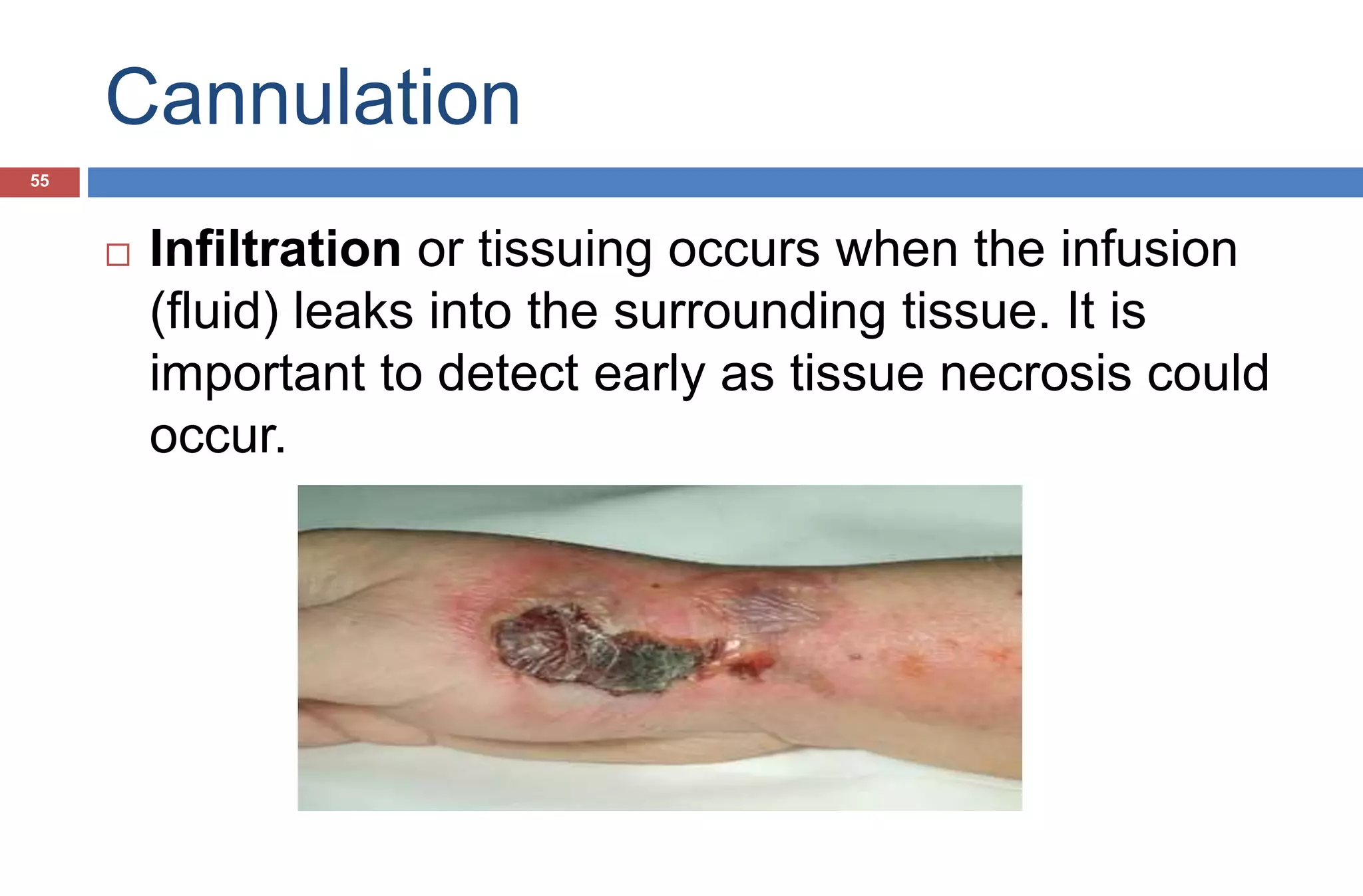 Cannulation
 Infiltration or tissuing occurs when the infusion
(fluid) leaks into the surrounding tissue. It is
important to detect early as tissue necrosis could
occur.
55
 