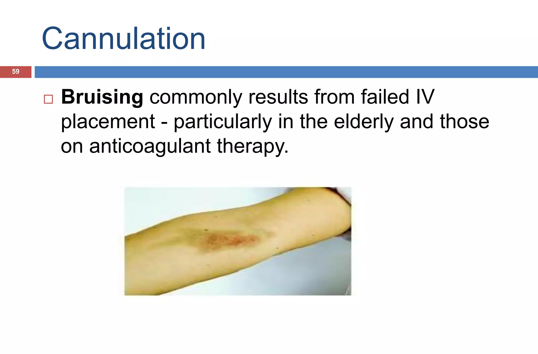 Cannulation
 Bruising commonly results from failed IV
placement - particularly in the elderly and those
on anticoagulant therapy.
59
 
