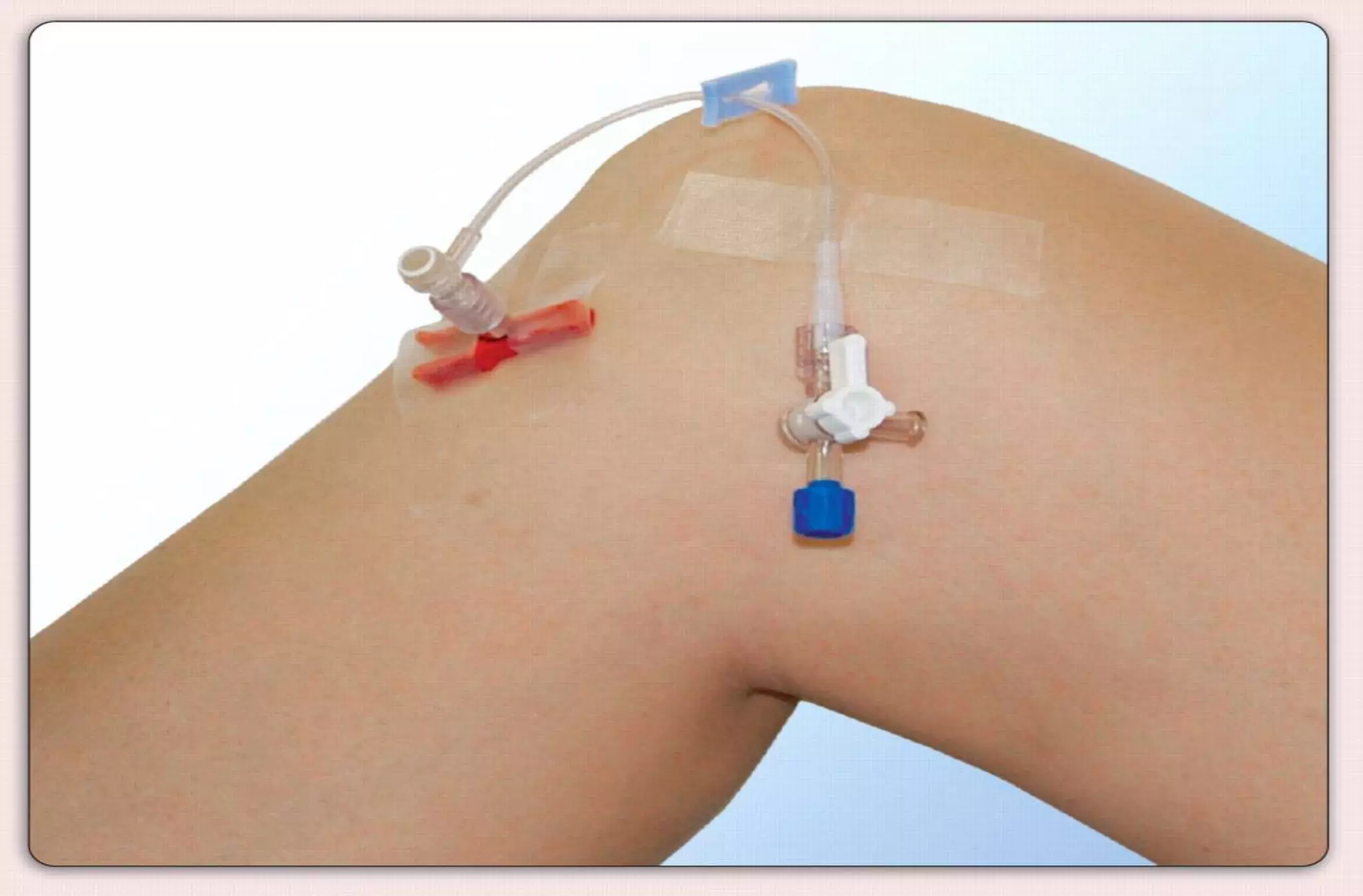  Infusion therapy may be dispensed
by I.V., subcutaneous, intraosseous
or intrathecal routes of
administration.
 