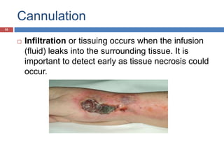 Cannulation
 Infiltration or tissuing occurs when the infusion
(fluid) leaks into the surrounding tissue. It is
important to detect early as tissue necrosis could
occur.
55
 