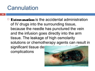 Cannulation
 Extravasation is the accidental administration
of IV drugs into the surrounding tissue,
because the needle has punctured the vein
and the infusion goes directly into the arm
tissue. The leakage of high osmolarity
solutions or chemotherapy agents can result in
significant tissue destruction, and significant
complications
24
 