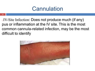 Cannulation
20
□IV-Site Infection: Does not produce much (if any)
pus or inflammation at the IV site. This is the most
common cannula-related infection, may be the most
difficult to identify
 