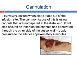 Cannulation
27
□Haematoma occurs when blood leaks out of the
infusion site. The common cause of this is using
cannula that are not tapered at the distal end. It will
also occur if on insertion the cannula has penetrated
through the other side of the vessel wall – apply
pressure to the site for approximately 4 minutes
and elevate the limb
 