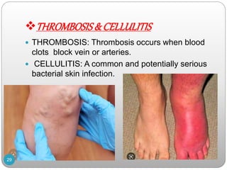THROMBOSIS& CELLULITIS
 THROMBOSIS: Thrombosis occurs when blood
clots block vein or arteries.
 CELLULITIS: A common and potentially serious
bacterial skin infection.
29
 