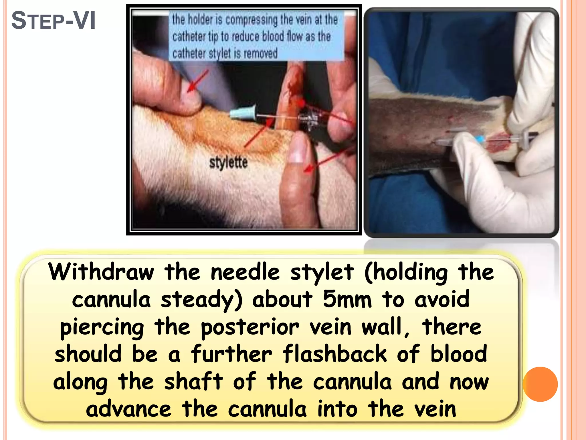 STEP-VI
Withdraw the needle stylet (holding the
cannula steady) about 5mm to avoid
piercing the posterior vein wall, there
should be a further flashback of blood
along the shaft of the cannula and now
advance the cannula into the vein
 