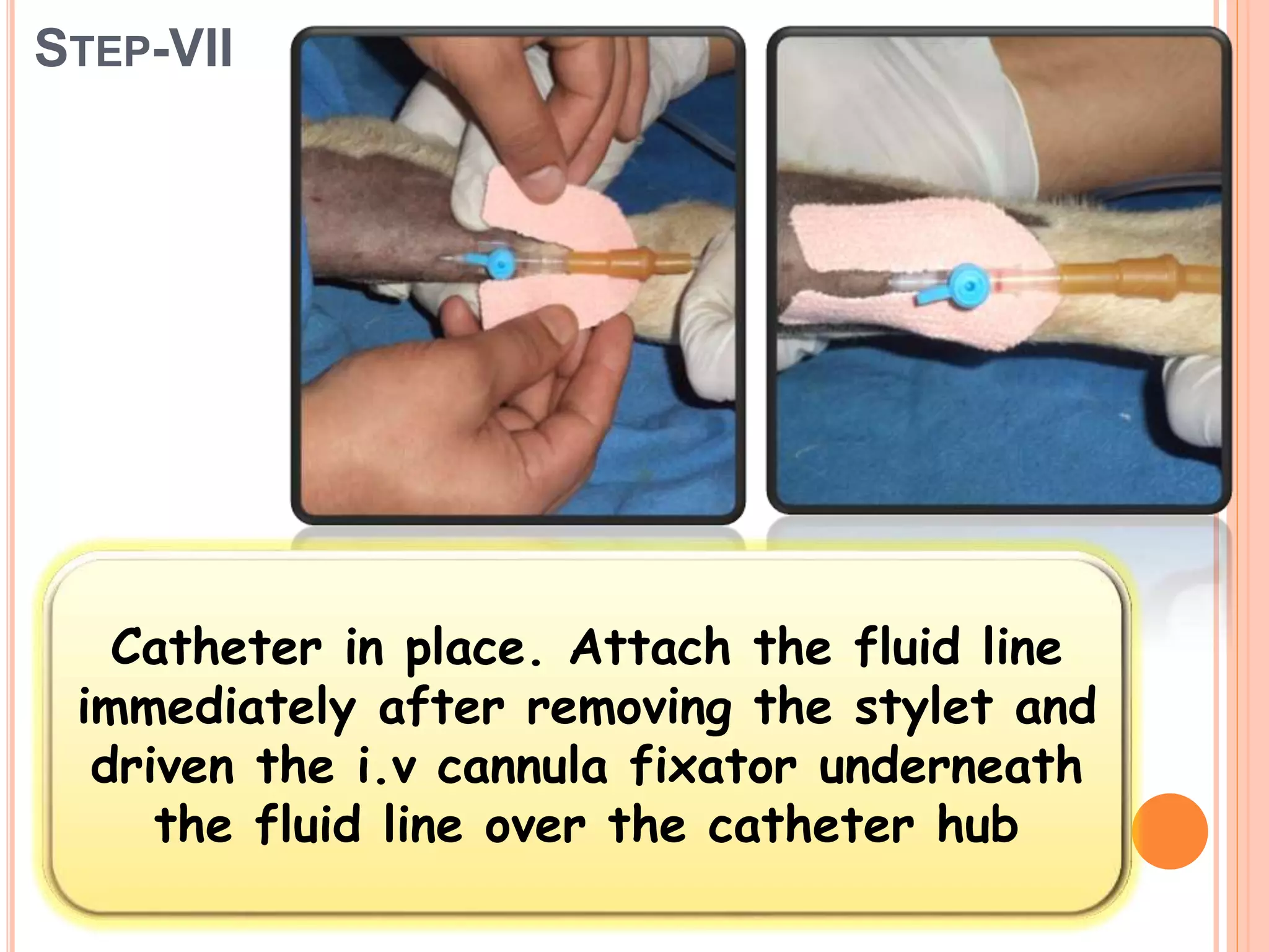 STEP-VII
Catheter in place. Attach the fluid line
immediately after removing the stylet and
driven the i.v cannula fixator underneath
the fluid line over the catheter hub
 