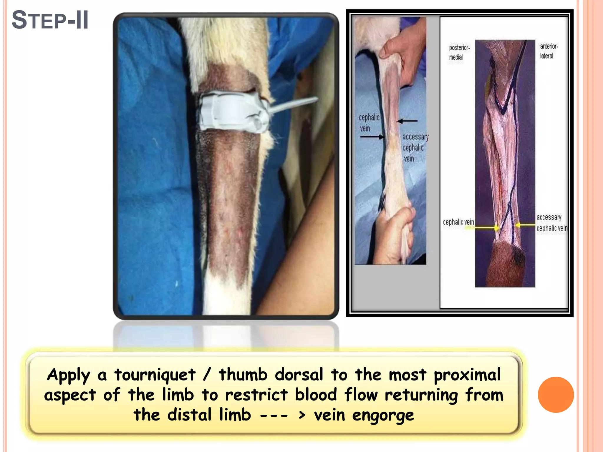 STEP-II
Apply a tourniquet / thumb dorsal to the most proximal
aspect of the limb to restrict blood flow returning from
the distal limb --- > vein engorge
 