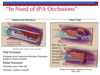 “In Need of tPA Occlusions”
          Intaluminal thrombus                                                  Fibrin Flap




           “Reopen the Pipeline”, Hadaway C, Nursing. 2005, 35(8)


Total Occlusion
Probable cause: Intraluminal thrombus Symptom:
Unable to infuse or aspirate

Partial Occlusion
Probable cause: Fibrin flap
Symptom: Unable to aspirate                                        “Reopen the Pipeline”, Hadaway C, Nursing.
                                                                                   2005, 35(8)
 