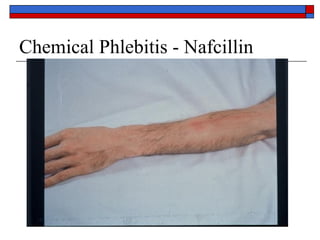 Chemical Phlebitis - Nafcillin
 