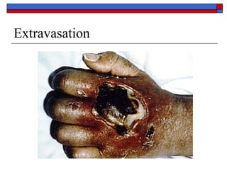 Extravasation
 