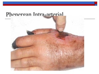 Phenergan Intra-arterial
 