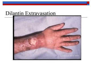 Dilantin Extravasation
 
