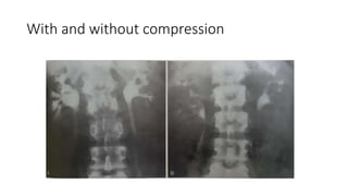 With and without compression
 