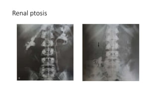 Renal ptosis
 