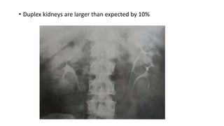 • Duplex kidneys are larger than expected by 10%
 