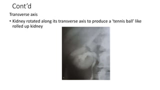 Cont’d
Transverse axis
• Kidney rotated along its transverse axis to produce a ‘tennis ball’ like
rolled up kidney
 