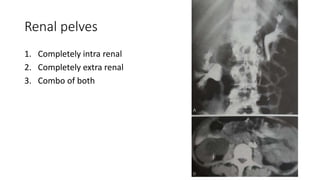 Renal pelves
1. Completely intra renal
2. Completely extra renal
3. Combo of both
 