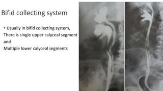 Bifid collecting system
• Usually in bifid collecting system,
There is single upper calyceal segment
and
Multiple lower calyceal segments
 