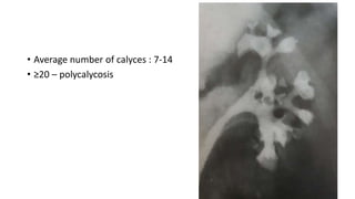 • Average number of calyces : 7-14
• ≥20 – polycalycosis
 