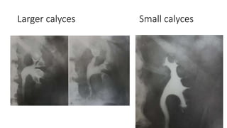 Larger calyces Small calyces
 