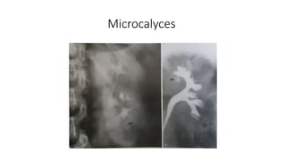 Microcalyces
 