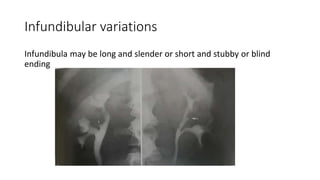 Infundibular variations
Infundibula may be long and slender or short and stubby or blind
ending
 