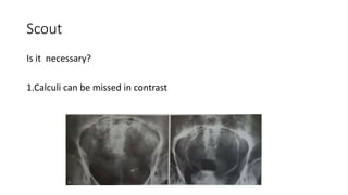 Scout
Is it necessary?
1.Calculi can be missed in contrast
 