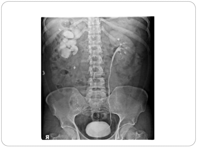 Intravenous urogram ( Sandip Gautam ) | PPTX
