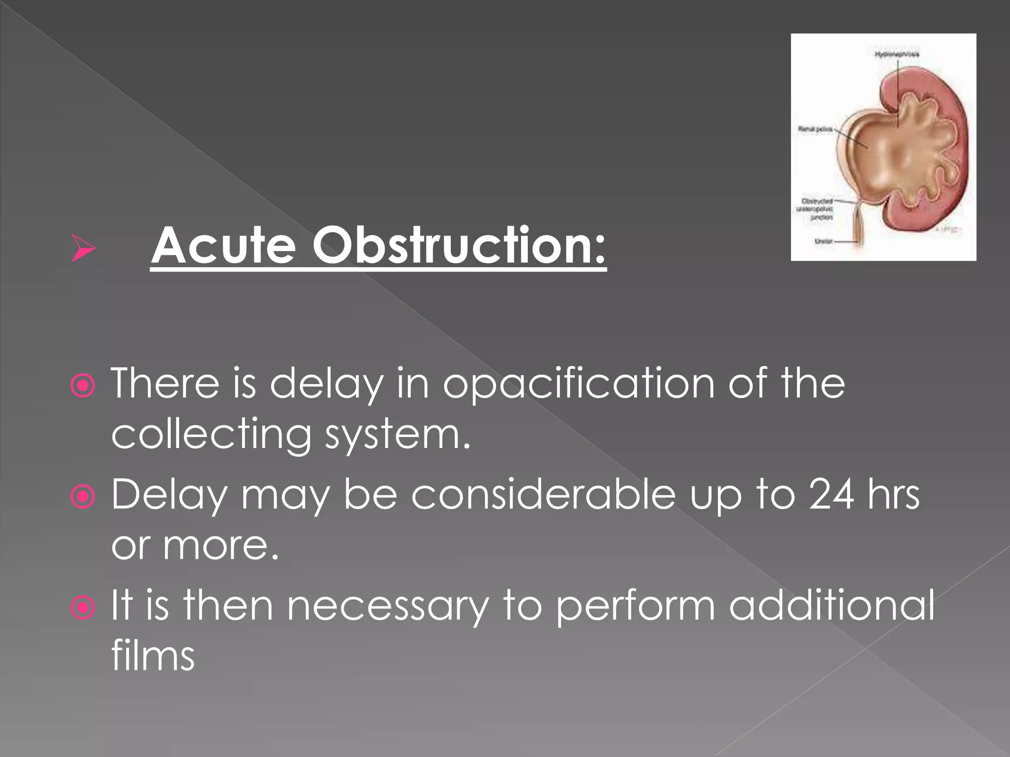  Acute Obstruction:
 There is delay in opacification of the
collecting system.
 Delay may be considerable up to 24 hrs
or more.
 It is then necessary to perform additional
films
 
