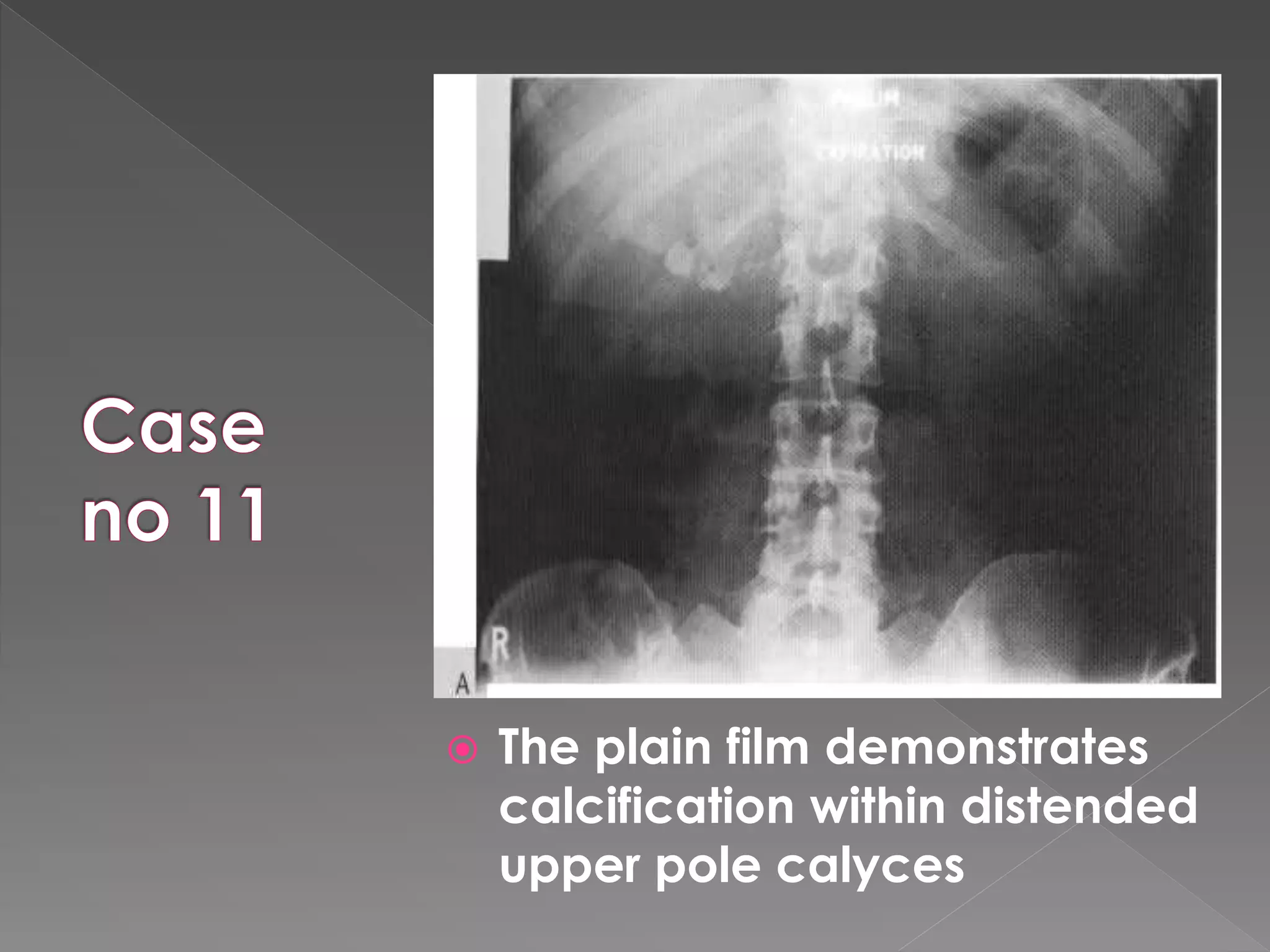  The plain film demonstrates
calcification within distended
upper pole calyces
 
