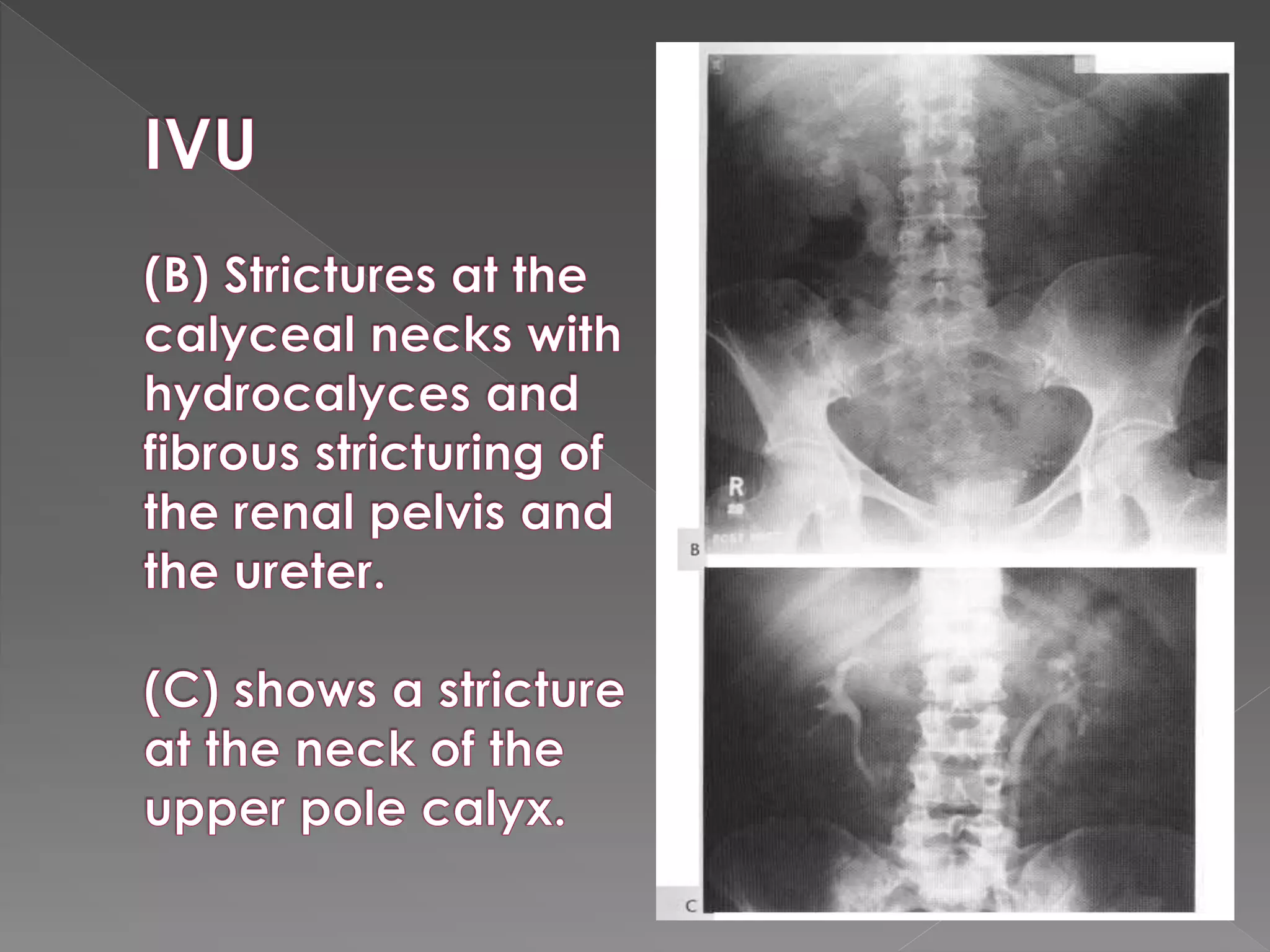 Intravenous urography