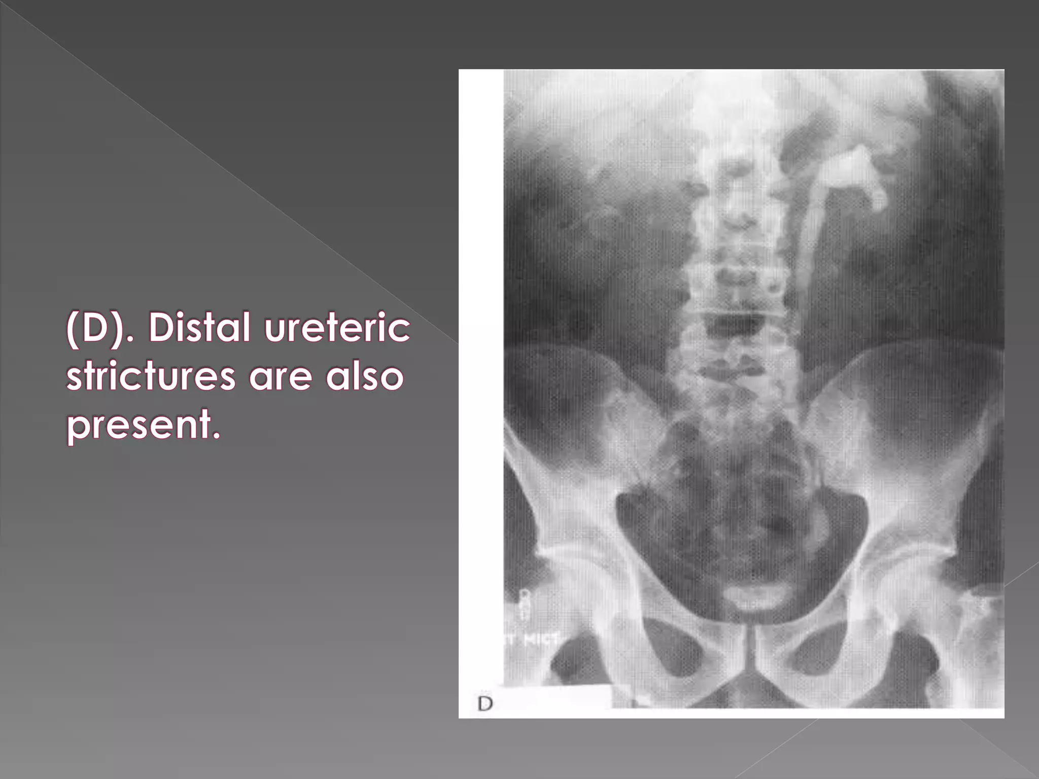 Intravenous urography