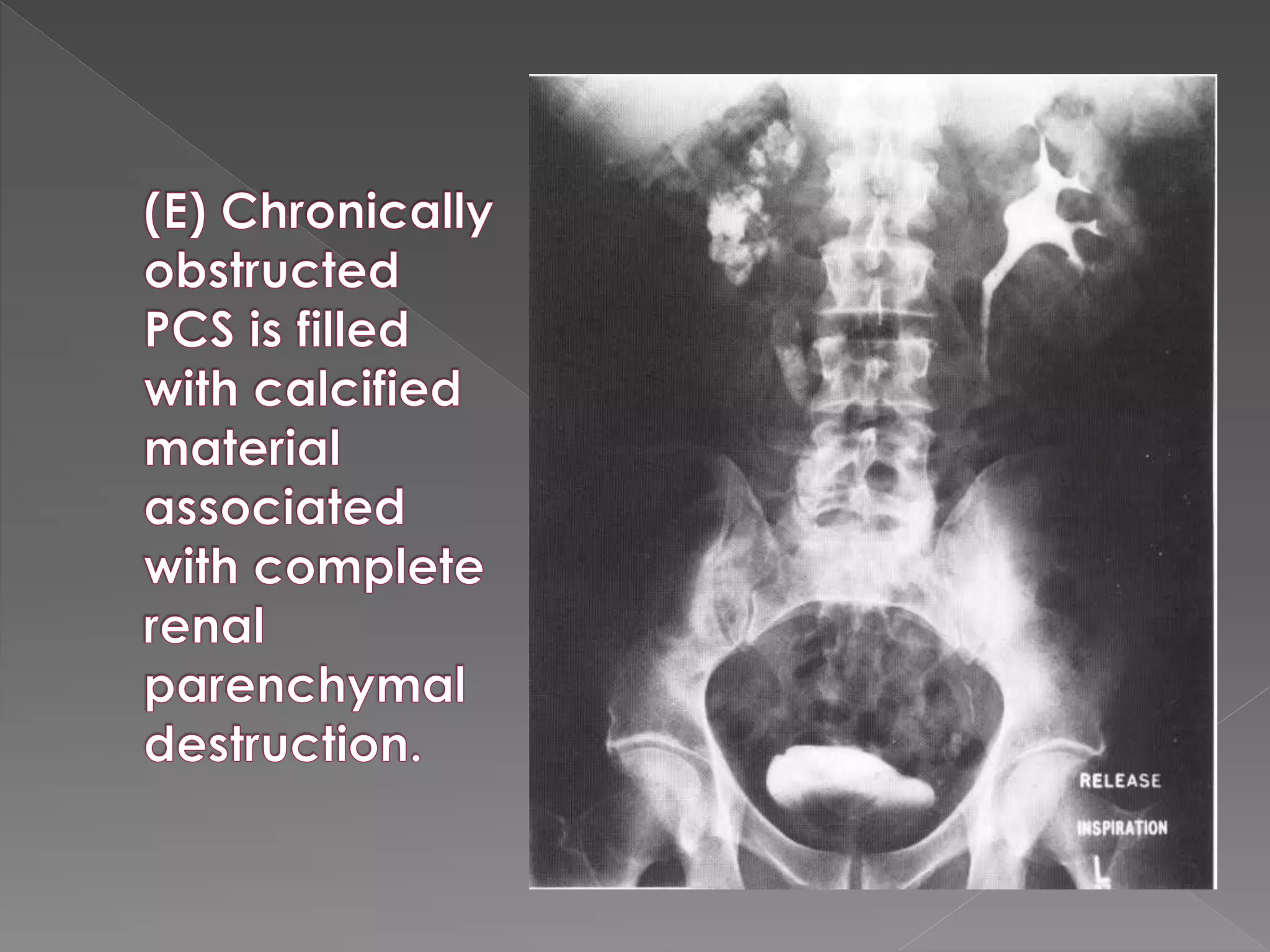 Intravenous urography