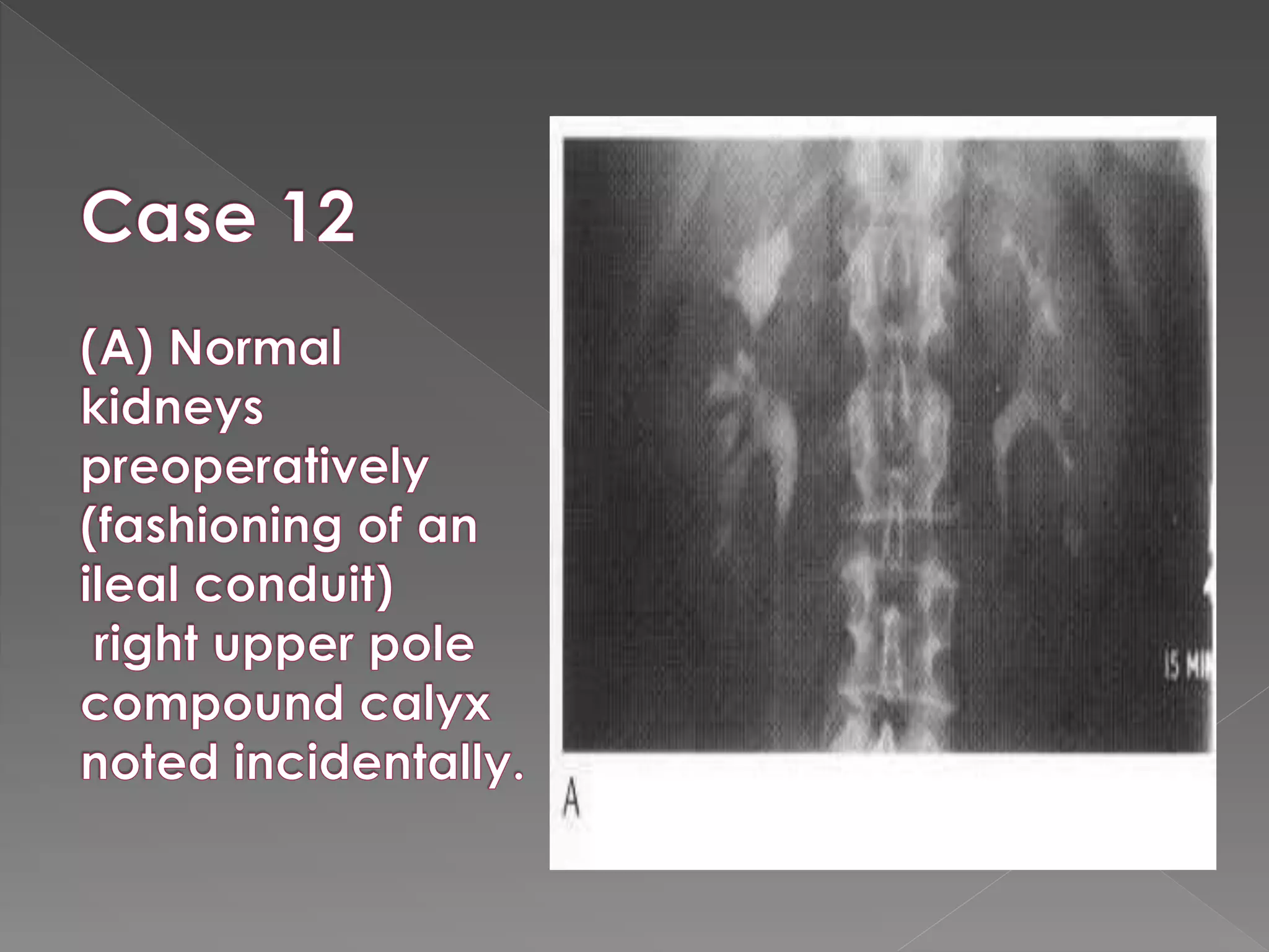 Intravenous urography