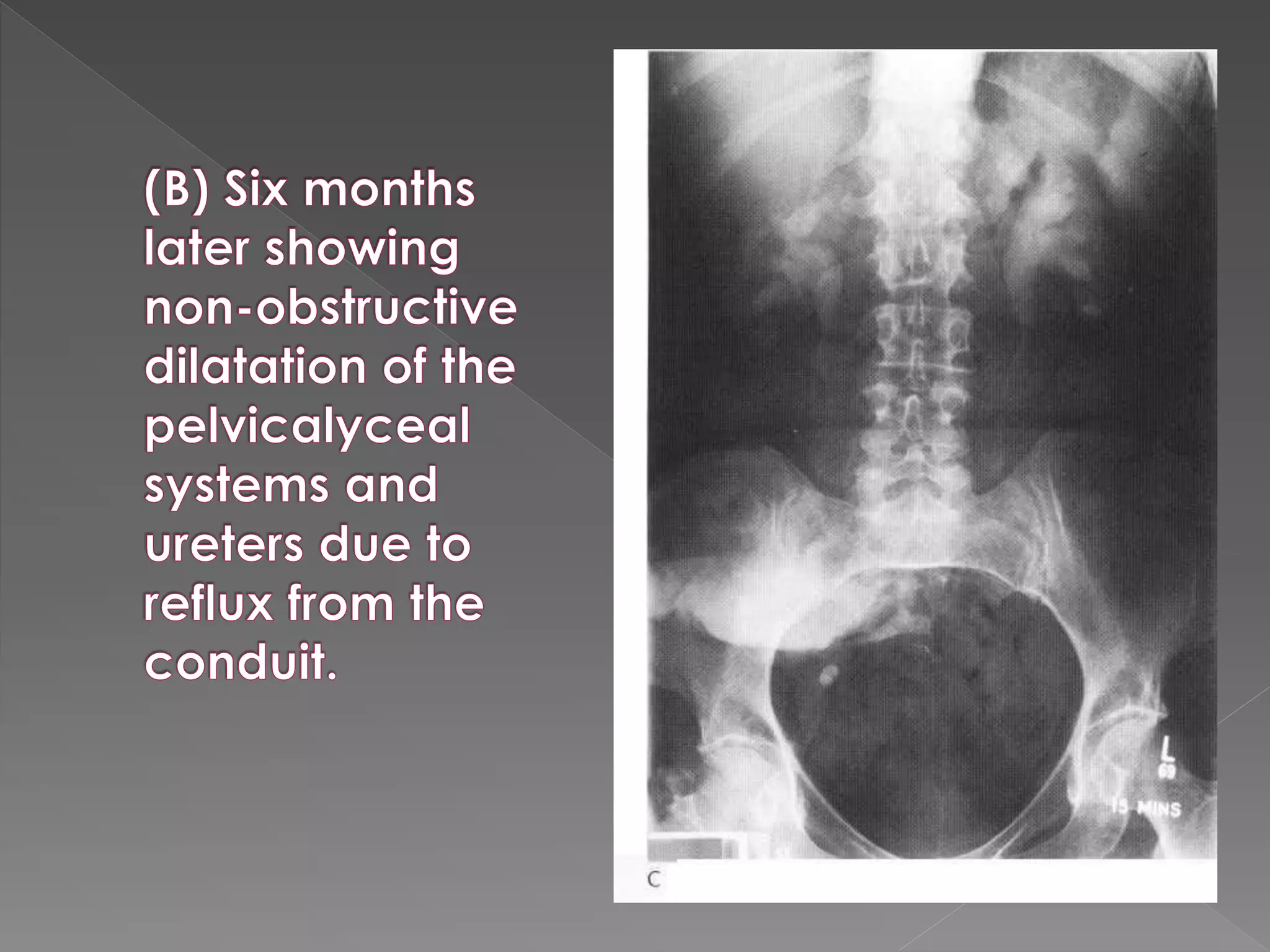 Intravenous urography