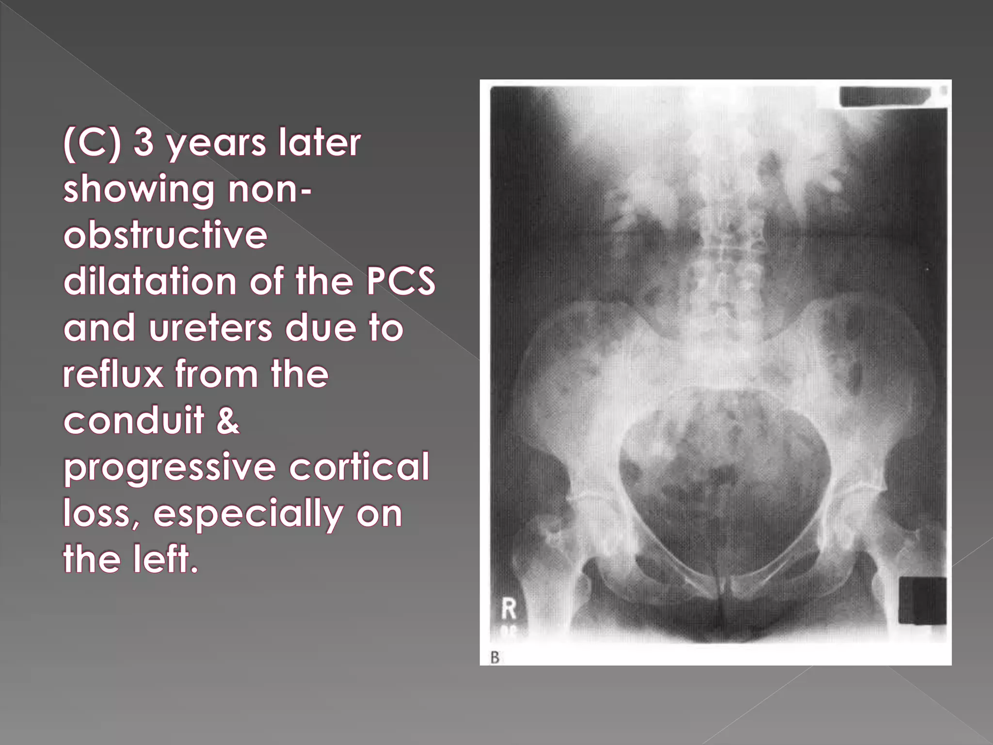 Intravenous urography