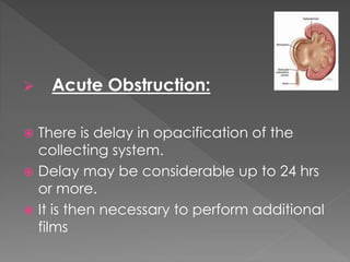  Acute Obstruction:
 There is delay in opacification of the
collecting system.
 Delay may be considerable up to 24 hrs
or more.
 It is then necessary to perform additional
films
 