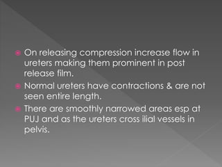  On releasing compression increase flow in
ureters making them prominent in post
release film.
 Normal ureters have contractions & are not
seen entire length.
 There are smoothly narrowed areas esp at
PUJ and as the ureters cross ilial vessels in
pelvis.
 