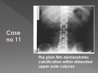  The plain film demonstrates
calcification within distended
upper pole calyces
 
