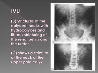 Intravenous urography