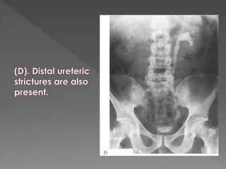 Intravenous urography