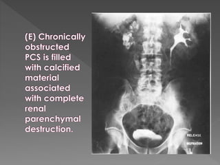 Intravenous urography