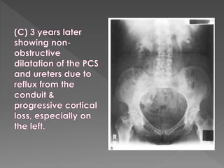 Intravenous urography
