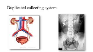 Dual Collection System Intravenous urography and its modifications.pptx 01 | PPTX