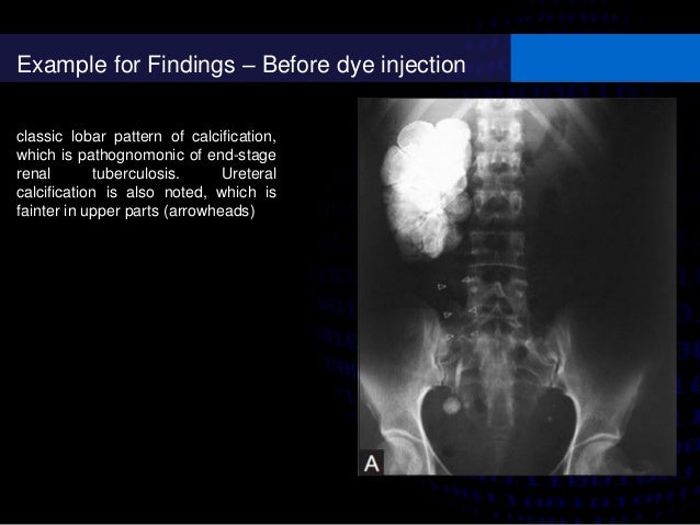 Intravenous urography (IVU)