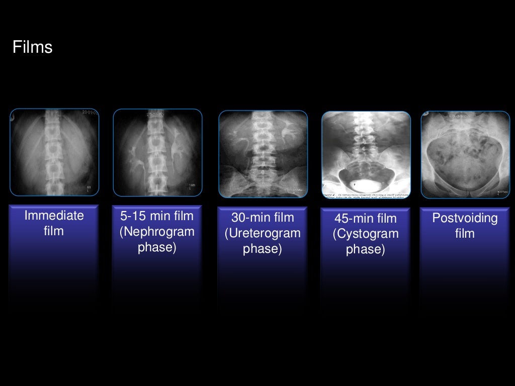 Intravenous urography (IVU)