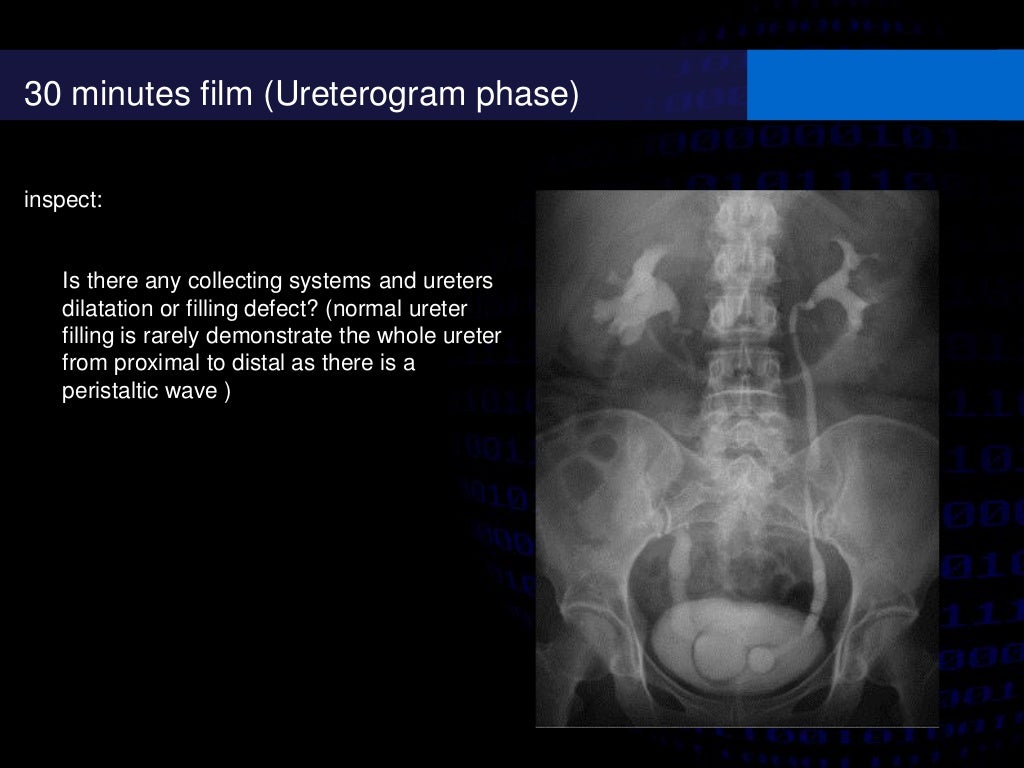 Intravenous urography (IVU)